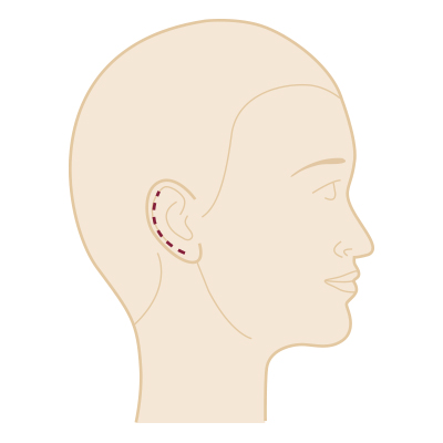 Grid Kopf: Narbenverlauf und mögliche Plastik-chirurgische Eingriffe - Operationen im Bereich Kopf