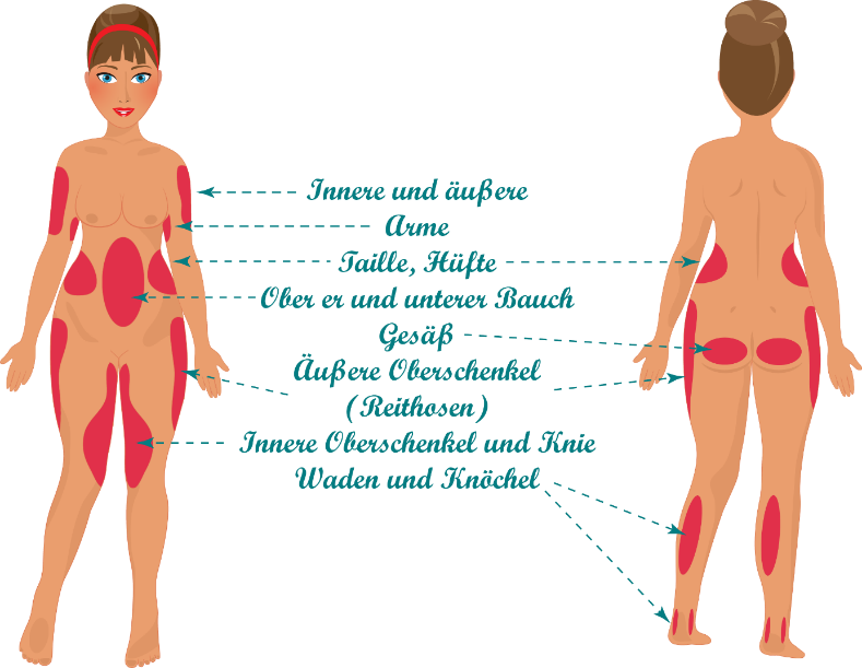 Gezeichnete Orte am Körper, Frau von vorne und hinten, an denen eine Fettabsaugung durchgeführt werden kann.